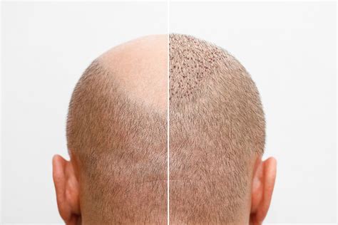 Best Practices Voor Haartransplantatie Nazorg
