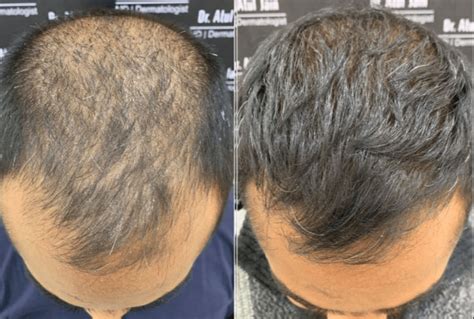 Haartransplantatie En Gezondheid: Wat Je Moet Weten