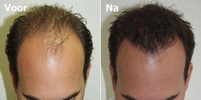 Haartransplantatie En Leeftijd: Is Het Altijd Mogelijk?